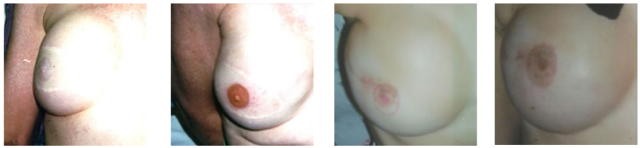 Areola Pigmentation – Permanent Makeup of Atlanta: Areola1