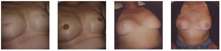 Areola Pigmentation – Permanent Makeup of Atlanta: Areola2