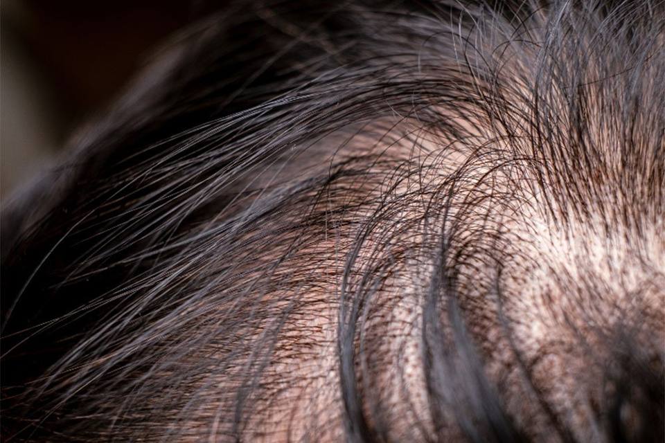 Woman's fuller hairline after scalp micropigmentation