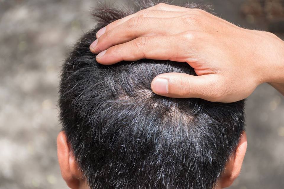 Revolutionizing Hair Restoration: Scalp Micropigmentation for Hair Loss