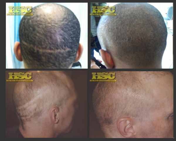 SMP for Hair Transplant Scars – Permanent Makeup of Atlanta: smp transplant1